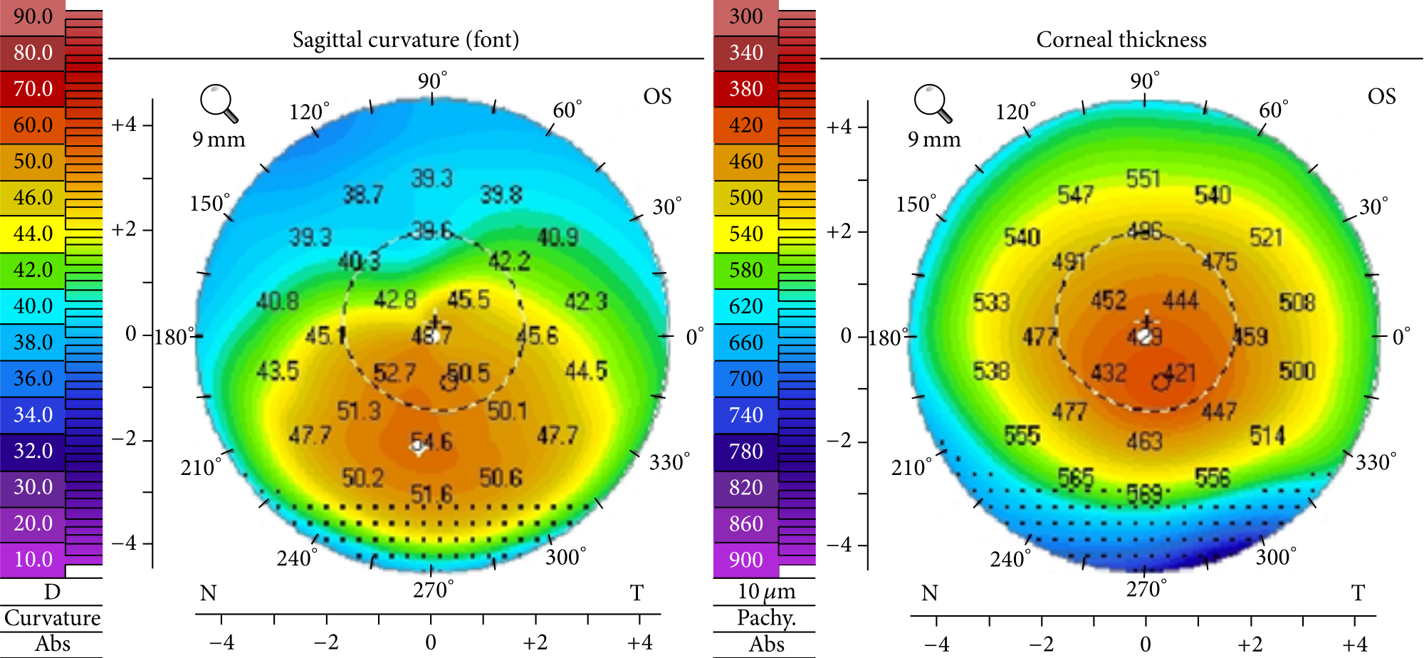 Corneal Topography for Diagnosing Keratoconus